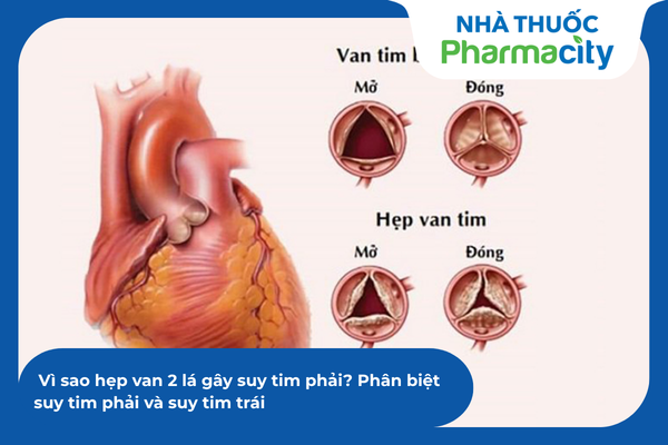 Vì sao hẹp van 2 lá gây suy tim phải? Phân biệt suy tim phải và suy tim ...