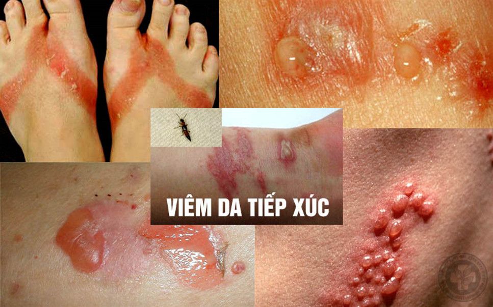 Viêm da tiếp xúc là phản ứng viêm da do tiếp xúc trực tiếp dị nguyên, không lây người khác