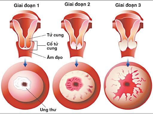 Tiêm vắc xin HPV và tầm soát định kỳ là bộ đôi hoàn hảo giúp phòng ngừa ung thư